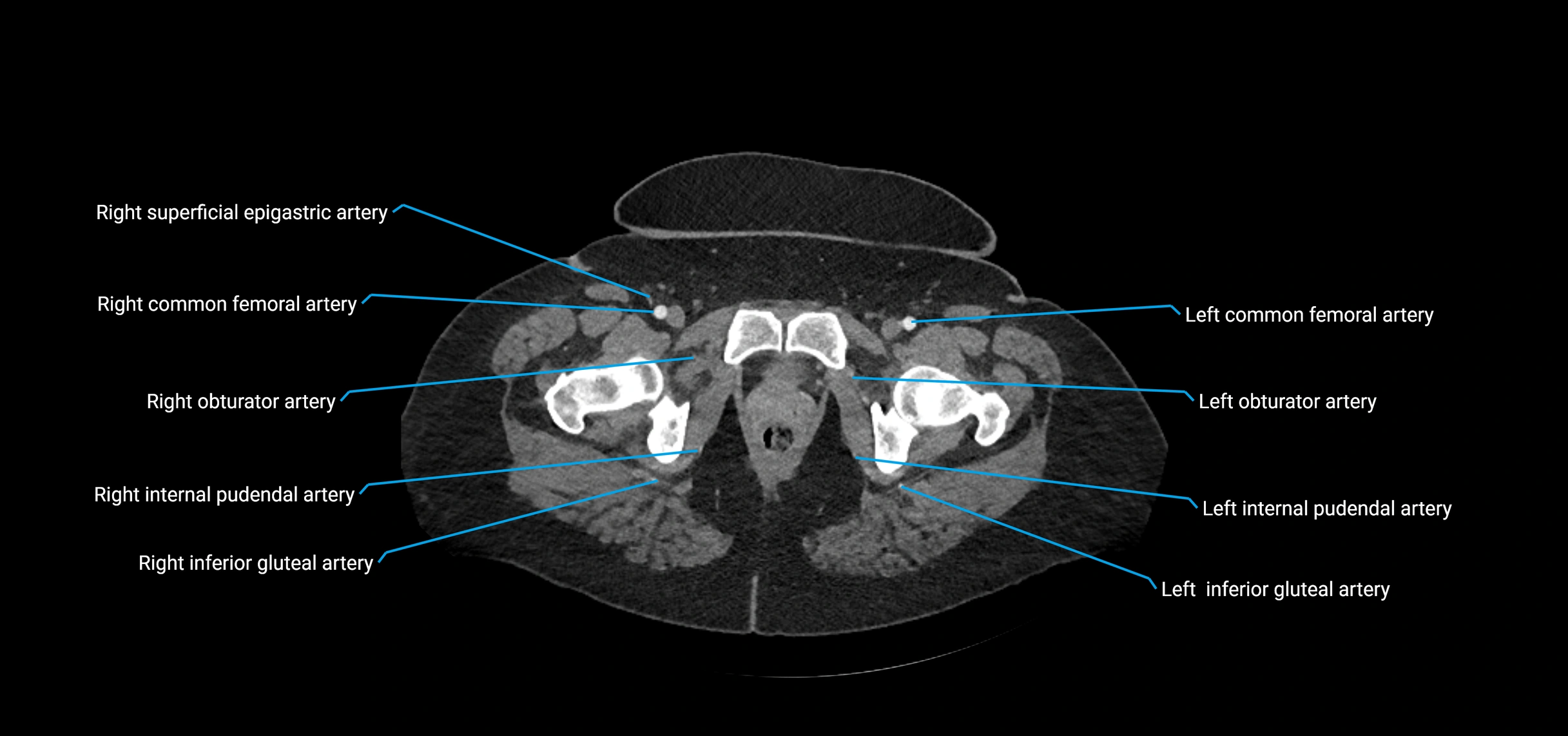 CTA abdomen axial cross sectional anatomy labelled image_259 (2).webp